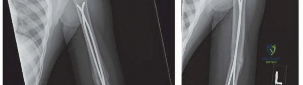 دليلك الشامل لعلاج الشلل الدماغي في اليد والذراع
