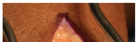 Illustration 3 for MTP Joint Arthrodesis: The Key to Optimal Toe Positioning