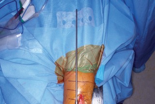 Illustration 33 for Mastering Valgus Total Knee Replacement: Techniques & Pitfalls