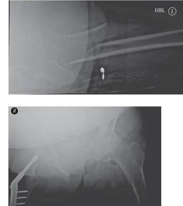 كسور تحت المدور في الفخذ: دليل شامل من التشخيص إلى التعافي مع الأستاذ الدكتور محمد هطيف
