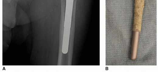 Illustration 5 for Mastering Revision THA: Strategies for Adverse Local Tissue Challenges