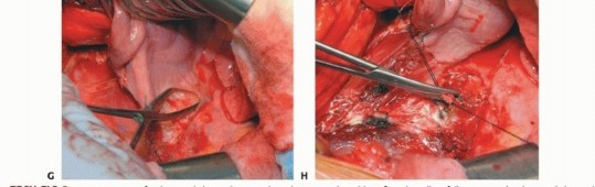 Illustration 27 for Anterior Interbody Arthrodesis for Scoliosis: What You Need to Know