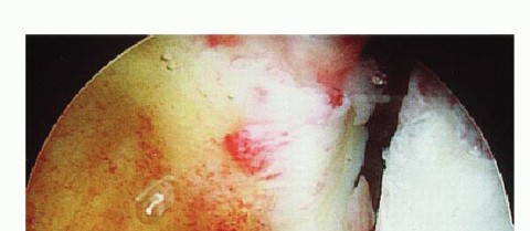 Illustration 3 for Regain Stability: Arthroscopy for Anterior Instability & the Inferior Glenohumeral Ligament