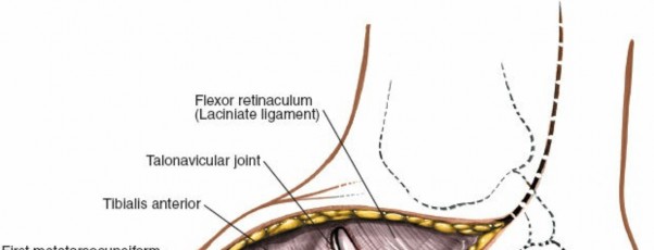 Illustration 185 for Optimized Approaches to the Dorsum of the Foot & Ankle