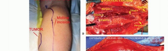 Illustration 6 for Soleus Resection for Tumors: Protecting the Heads of the Gastrocnemius