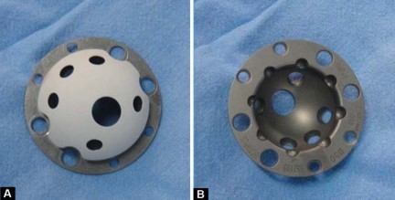 Illustration 9 for Optimizing Arthroplasty in Acute Fractures: Octopus System