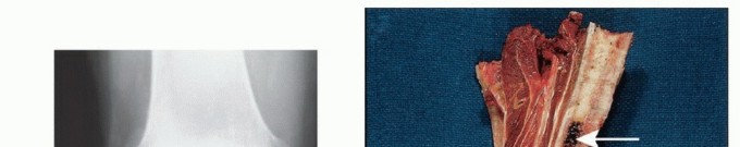 Illustration 10 for Below-Knee Amputation: Maximize Your Below-Knee Recovery & Function