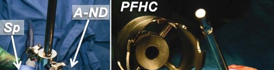 Illustration 82 for Birmingham Hip Resurfacing Designer's Technique for Active Lives