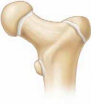 Unlock better outcomes: Pediatric hip fractures & lateral femoral cortex