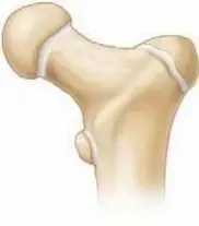 كسور الورك عند الأطفال: دليل شامل للآباء ورعاية متخصصة في اليمن