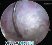 Illustration 15 for Cruciate Ligament Repair: Definitive Guide to Treatment & Recovery