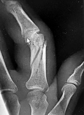 صورة طبية: دليل الأستاذ الدكتور محمد هطيف الشامل لأمراض وإصابات اليد والمعصم في صنعاء