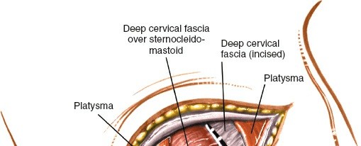Illustration 7 for Mastering the Anterior Cervical Approach: Longus Colli Muscle Insights