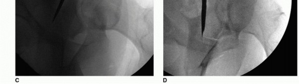 صورة توضيحية لـ جراحة قطع العظم حول الحُق وقطع عظم الفخذ: إعادة محاذاة مفصل الورك لراحة دائمة مع الأستاذ الدكتور محمد هطيف