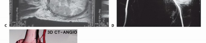 Illustration 4 for Complex Popliteal Resections: Protecting the Greater Saphenous Vein