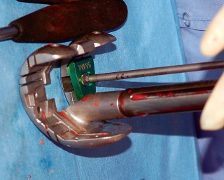 Illustration 42 for Mastering Gap Balancing in Revision TKA: Avoid Common Pitfalls