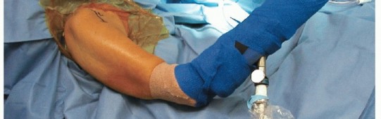 Illustration 9 for Bankart Repair & Inferior Capsular Shift: Solving Shoulder Instability