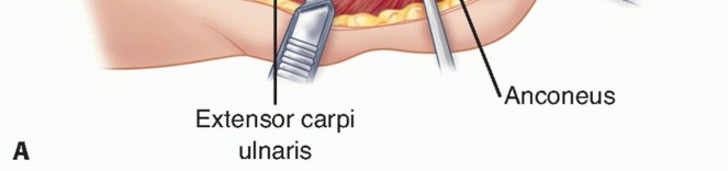 Illustration 10 for Radial Head Arthroplasty: Restoring Elbow Function & Stability