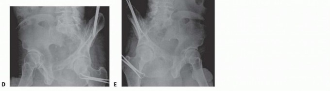 Illustration 10 for Achieve Stable Fixation of the Symphysis: Open Reduction