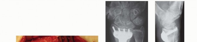 Illustration 25 for Precision Correction for Distal Radius Malunion