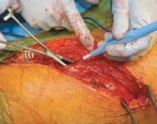 Illustration 35 for Mastering Anterior Interbody Arthrodesis with Instrumentation for Scoliosis