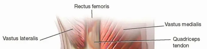 صورة توضيحية لـ تصلب مفصل الركبة بعد جراحة المراجعة: الأسباب، التشخيص، والعلاج الأمثل مع الأستاذ الدكتور محمد هطيف في صنعاء