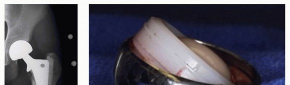 Illustration 30 for Allograft Prosthetic Composite: Mastering Proximal Femur Reconstruction