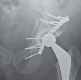 Illustration 65 for Navigating Early THA for Fractures of the Acetabulum