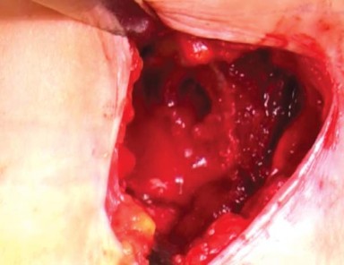 Illustration 17 for Mastering the Anterolateral Approach in Minimally Invasive Hip Replacement