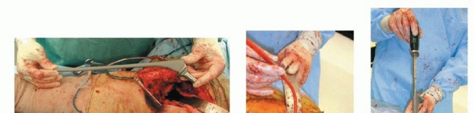Illustration 16 for Regain Mobility: Total Hip Arthroplasty for Malignant Lesions