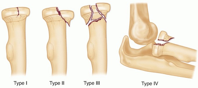 Illustration 11 for Radial Head & Neck Fractures: Mastering ORIF for Best Results