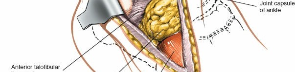 Illustration 96 for Optimized Approaches to the Dorsum of the Foot & Ankle