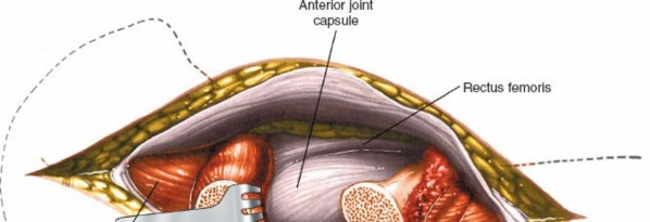 Illustration 114 for Unlocking Every Aspect of the Hip's Surgical Approaches