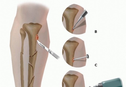 Illustration 23 for Tibia External Fixation: See How Pins Are Placed for Healing