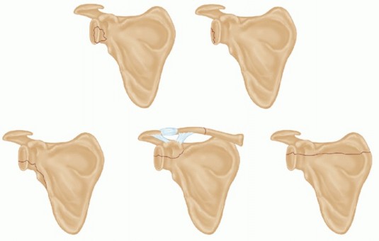 Navigating Fractures of the Glenoid: When Surgery is Best