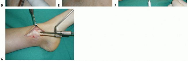 Illustration 10 for Painful Talus Lesions? The tech fig c Osteochondral Transfer Solution