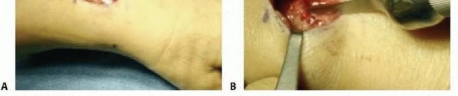 Illustration 20 for Distal Radius Fixation: Precision Through Lister's Tubercle