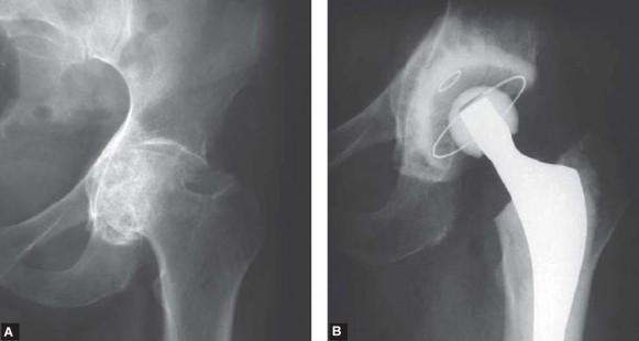 Illustration 36 for Optimizing Acetabular Component Cementation for Superior Outcomes