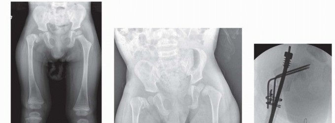 Illustration 24 for Less Pain, More Function: Fassier-Duval Nailing for Osteogenesis Imperfecta