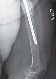 Illustration 35 for THA for patients with proximal femoral deformity: Practical solutions