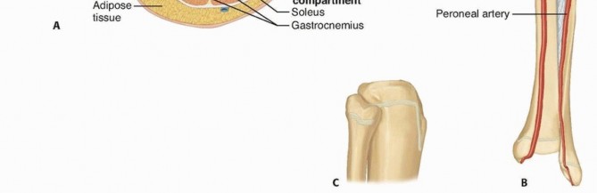 Illustration 3 for Optimal Treatment for Pediatric Tibial Fractures: Key Insights
