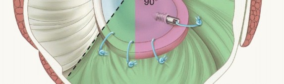 Illustration 8 for Regain Stability: Arthroscopy for Anterior Instability & the Inferior Glenohumeral Ligament