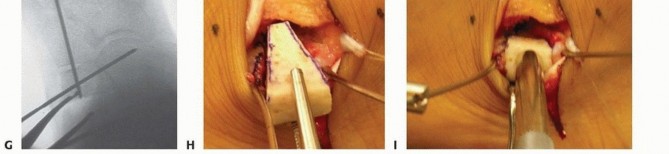 Illustration 16 for Calcaneal Lengthening Osteotomy: Correcting Hindfoot Valgus