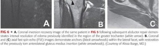 Illustration 61 for Periarticular Arthroscopy: Addressing Medius & Minimus Tears