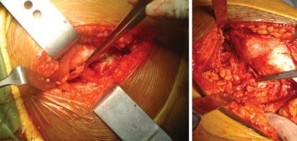 Illustration 15 for Total Hip Arthroplasty: Restoring Mobility in Juvenile Idiopathic Arthritis