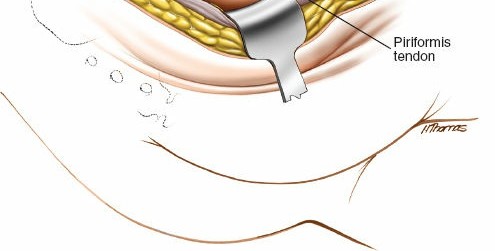 Illustration 131 for Pelvis & Acetabulum Approaches: Unlocking the Posterior Superior Iliac