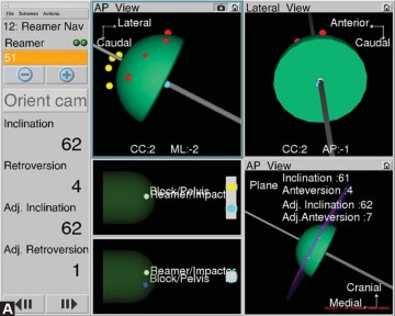 Illustration 20 for Avoiding Errors: Navigation in Total Hip Arthroplasty