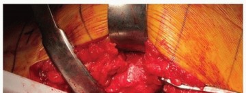 Illustration 20 for Uncemented Acetabular Revision: Optimizing Hemispherical Cup Use