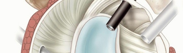 Illustration 21 for Regain Stability: Arthroscopy for Anterior Instability & the Inferior Glenohumeral Ligament