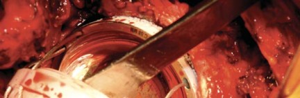 Illustration 64 for Birmingham Hip Resurfacing Designer's Technique for Active Lives